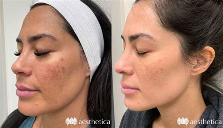 face peel